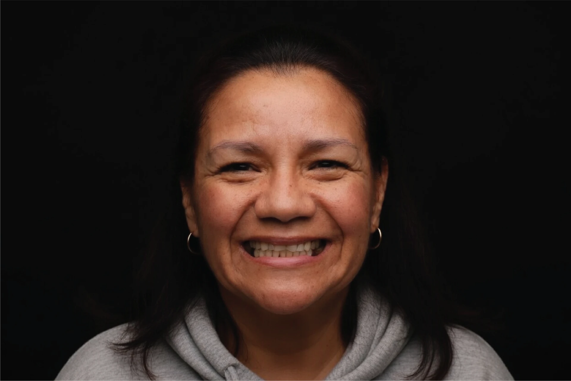 Patient smile before ORA 4X treatment