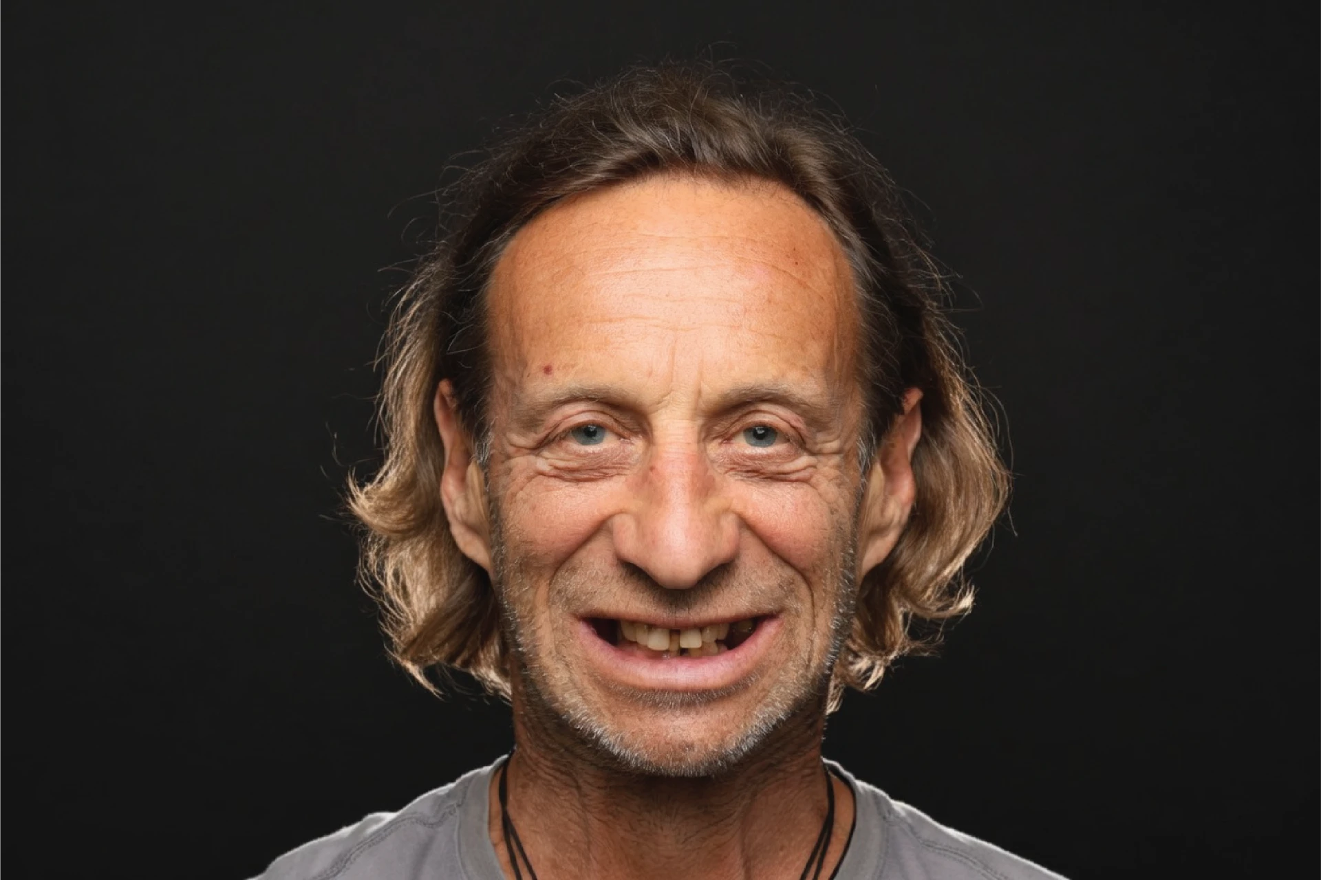 Patient smile before ORA 4X treatment